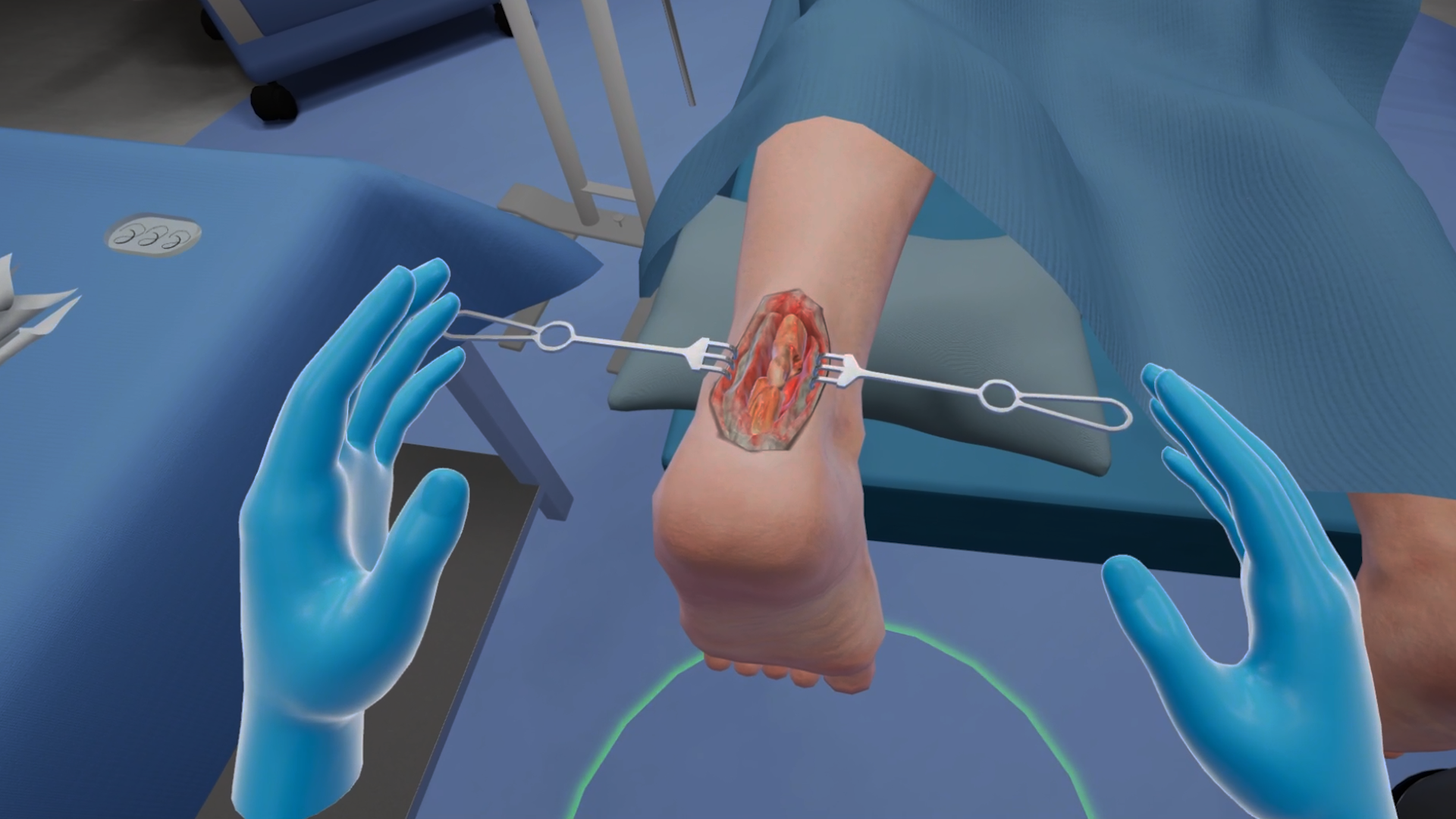 Achilles Tendon Repair | MedVR Education